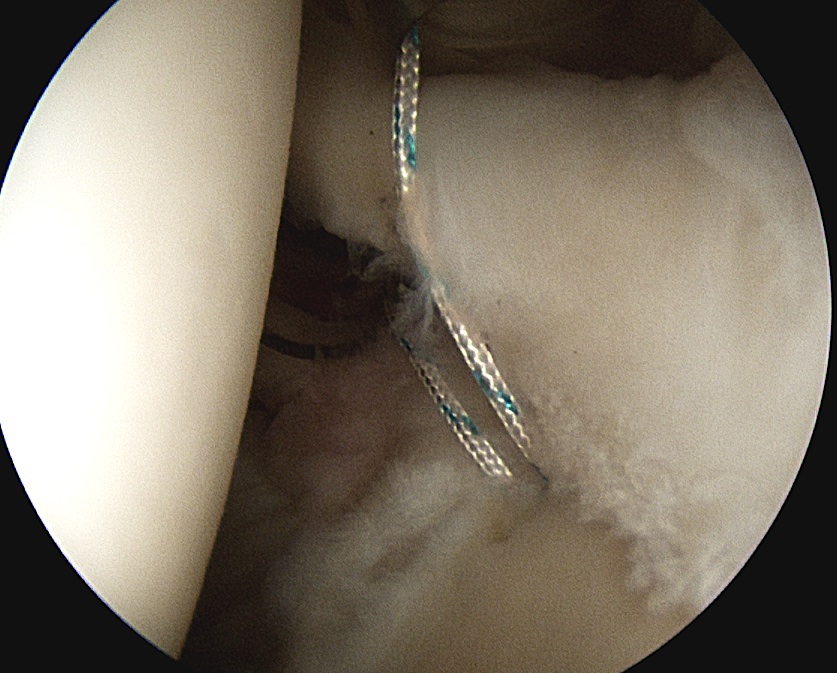 Shoulder SLAP Repair Suture Management